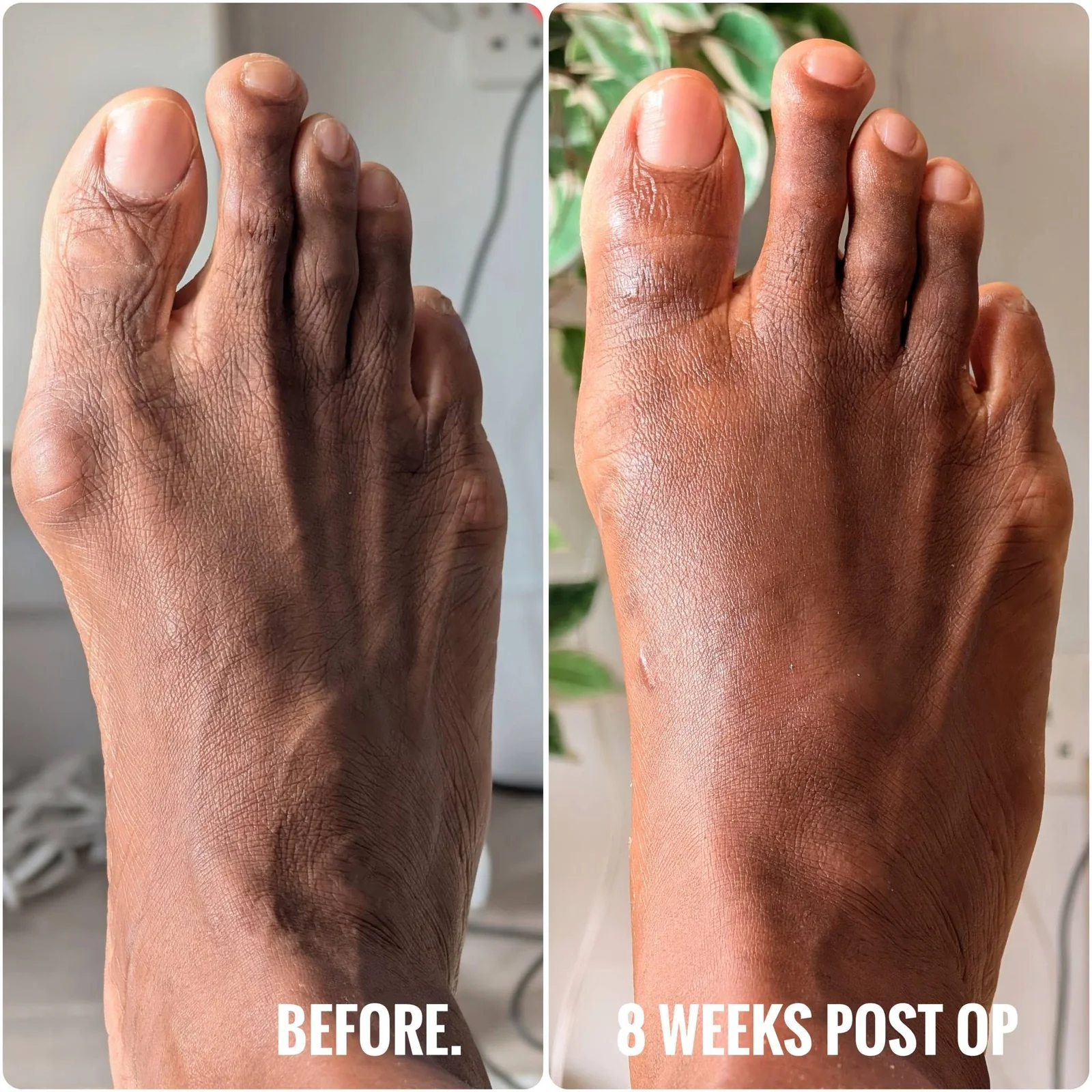 May be an image of text that says 'BEFORE. 8 WEEKS POST WEEKSPOSTOP OP'
