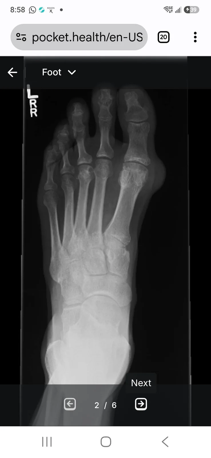 May be an image of bone, xray and text that says '8:58 E6E 39 으 pocket.health/en-US 20 Foot ই Next 2/6 →'