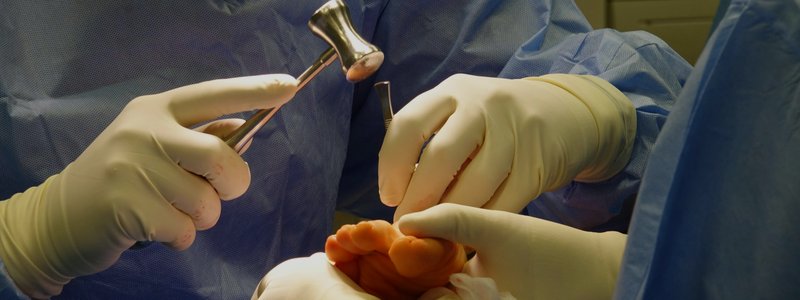 Lapiplasty 3D Bunion Surgery